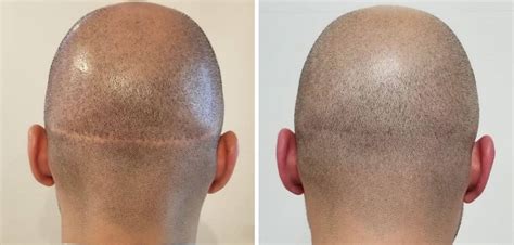 Improve your scars appearance by Hair Transplant on Scars