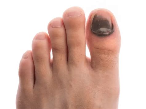 Black Toenail: 5 Common Causes and Treatment (A Helpful Guide)