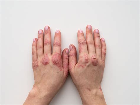 Psoriasis Hands Psoriasis Or Hand Eczema : R/Psoriasis