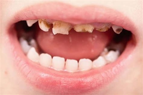 Children's rotten teeth cost hospitals £35m per year - North Street Dental