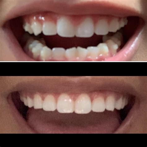 Worth every single penny! All done. : r/Invisalign