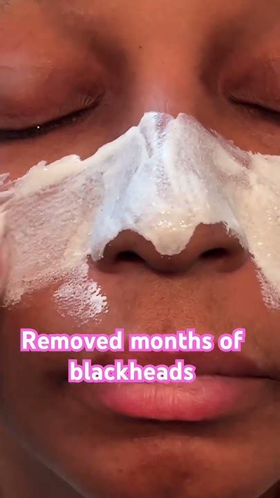 Unbelievable Blackhead Removal 2024: The #1 Trend You Need To Know About - 3w1o8pv