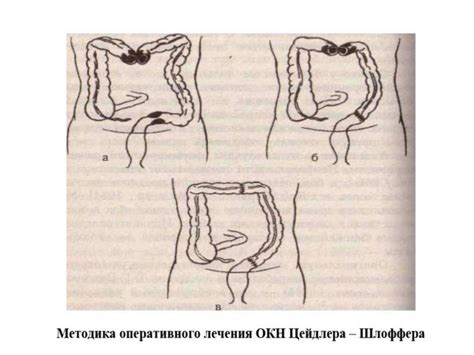 Острая кишечная непроходимость - online presentation