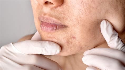 Pico Laser for Acne Scars: A Comprehensive Guide - Health Blogster