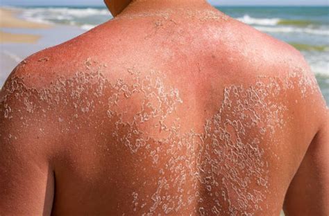 How To Safely Treat Sunburn Peeling