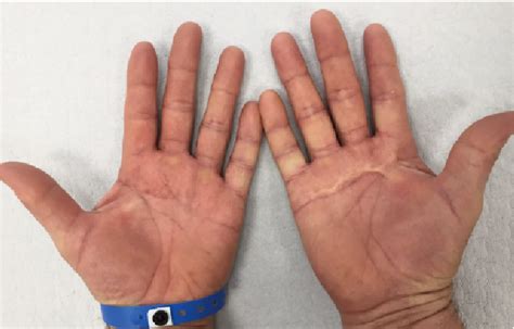 figure   keratolysis exfoliativa  eruption induced