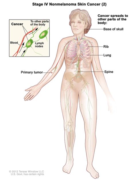 Stages of Skin Cancer - Navigating Care