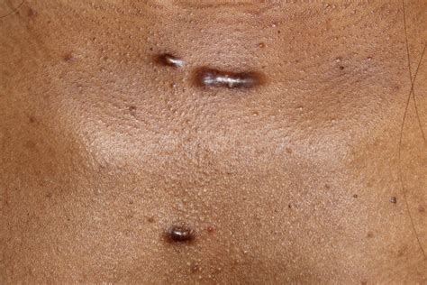 Keloids
