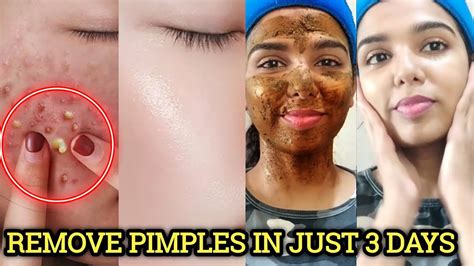 Does Staying Up Late Give You Pimples | Detroit Chinatown