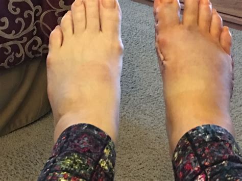 How Long After Surgery Shower at Brian Iverson blog