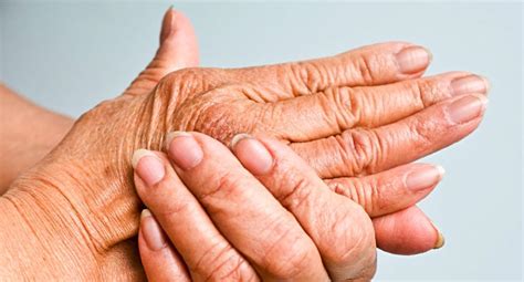 What do you know about Psoriatic Arthritis? – M-Folia