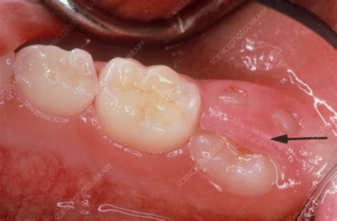 Erupting molar - Stock Image - C058/4604 - Science Photo Library