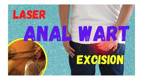 Wart Treatment Itchy at Jerry Matos blog