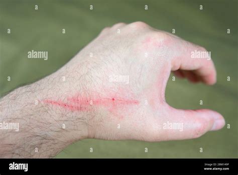 Katzenkratzkrankheit Stockfotos und -bilder Kaufen - Alamy