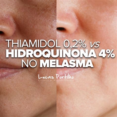 Thiamidol É Um Ácido - Thiamidol 0,2% versus 4% hydroquinone