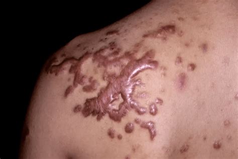 how to stop a keloid from growing at home