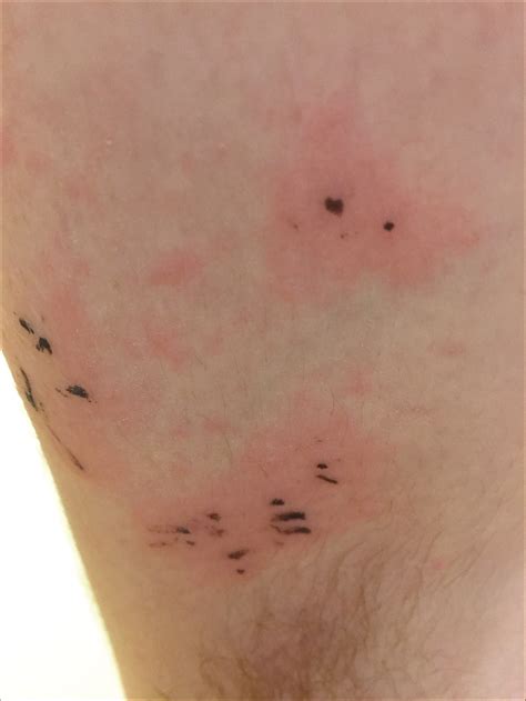 Black Dot Poison Ivy Rash Is This Black Spot Poison Ivy? Came Up After