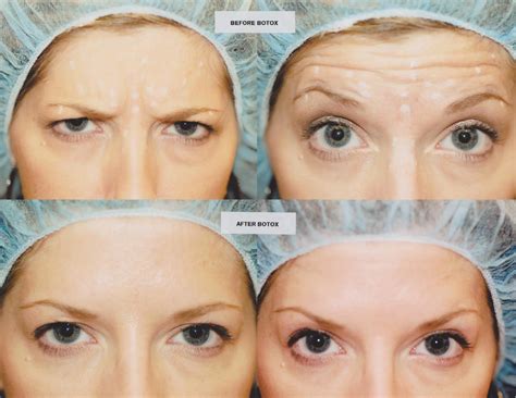 forehead line botox 2