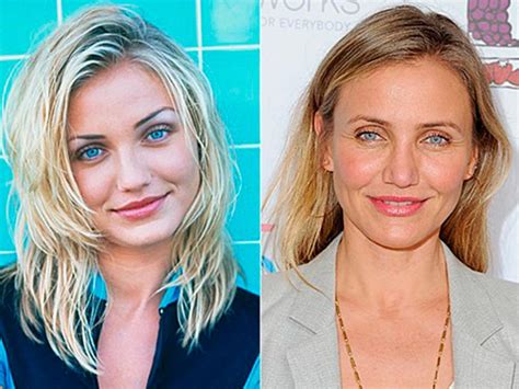 Blefaroplastia Antes E Depois Famosos - Blefaroplastia Recuperação - Cuidados pós-operatório | Dream