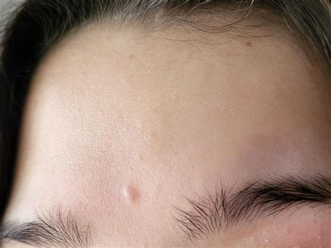 Bump on forehead that has been there for years : r/SkincareAddicts