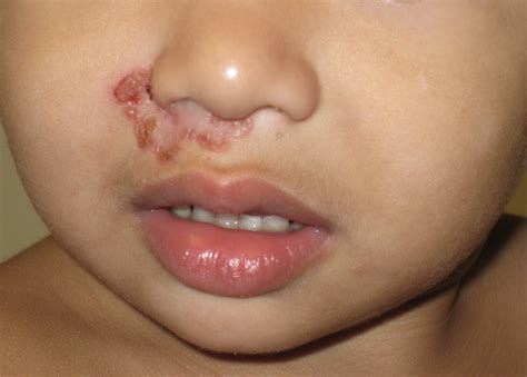 Impetigo I Nostril Bacterial Infections Of The Skin And Eyes