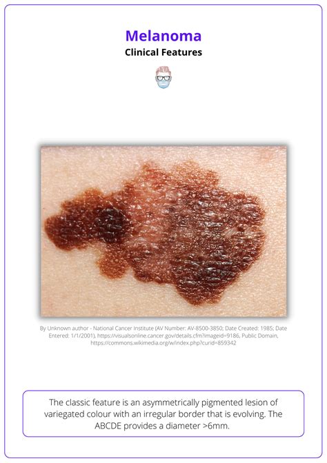 Melanoma Jinak at Caitlin Gilles blog