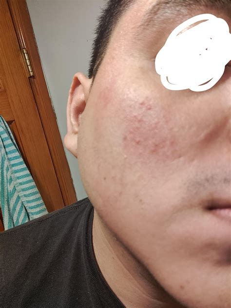 Red cheeks and pimples. : r/Skincare_Addiction