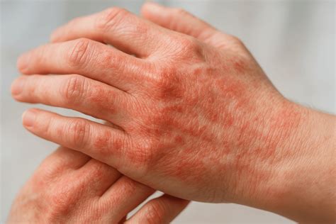 treat eczema expert tips  relief doctronic