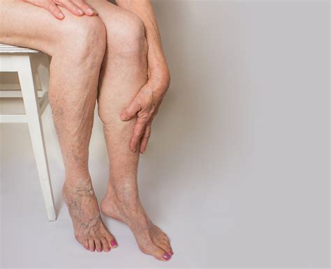 Compression Stockings for Varicose Veins & Venous Insufficiency