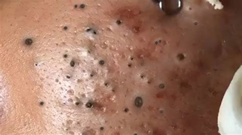 Experts Warn: This Unbelievable Blackhead Removal 2024 Trend is Dangerous! - hny56g2