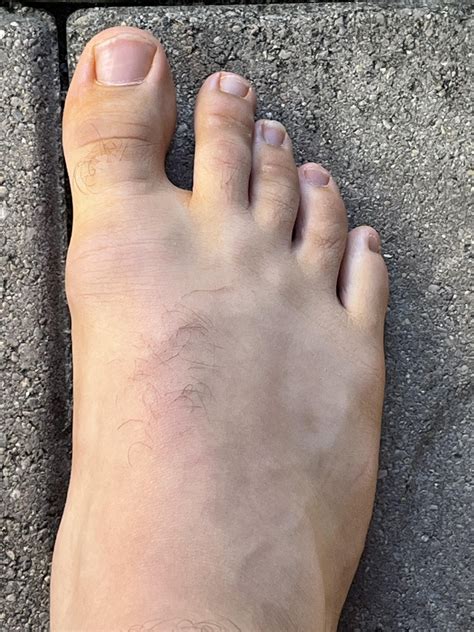 What can I do to straighten my toes? : r/FootFunction