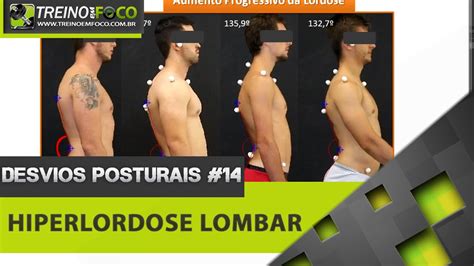 Hiperlordose Lombar Antes E Depois - Hiperlordose Antes E Depois - RETOEDU