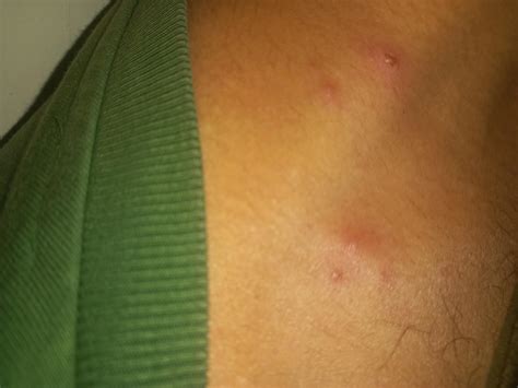 please someone is this folliculitis ? : r/Folliculitis