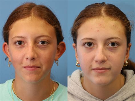 Otoplasty Before & After | Dr. George Miguel