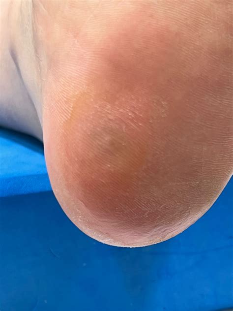 Everlasting Verrucas