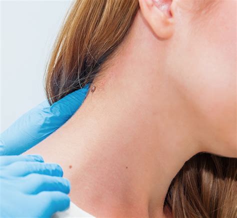 Understanding and Preventing Intertrigo: Causes, Symptoms, and Treatments