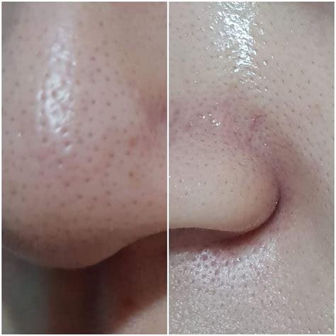 Unbelievable Blackhead Removal 2024: My Honest Review & Before/After Pics. Image 17