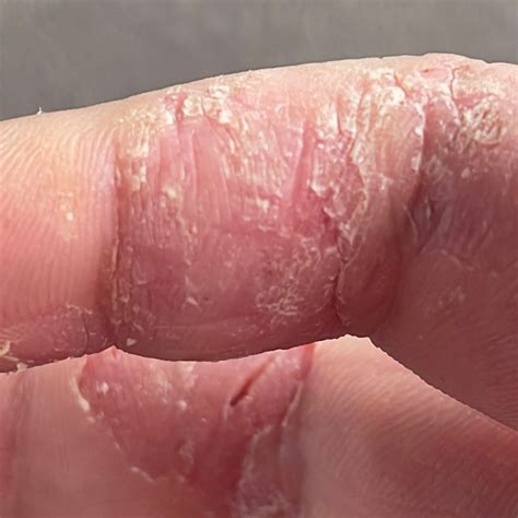 Eczema (ICD-10: L20-L30) - Online consultation AI dermatologist