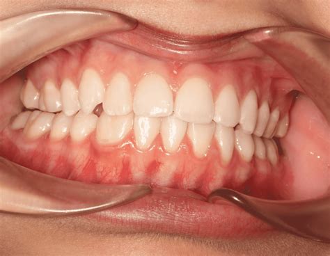 Case Gallery - Patient Transformations | Inspire Dental