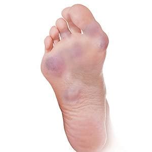 Foot Rheumatoid Arthritis Dallas TX | Foot Fracture Dallas | Foot Pain ...