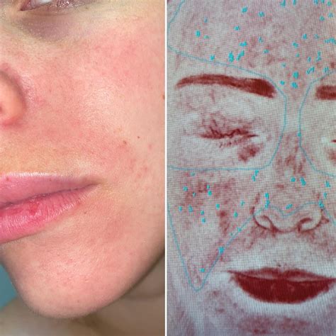 Perioral dermatitis? : r/DermatologyQuestions