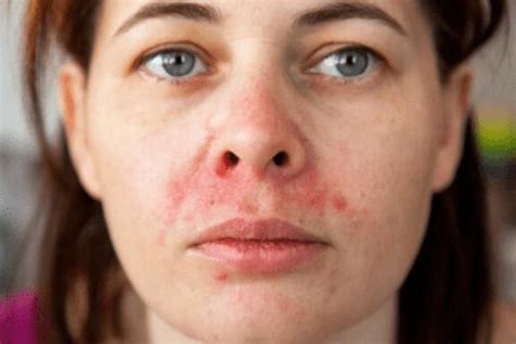 Seborrhoisches Ekzem: Behandlung und Therapie | Ducray
