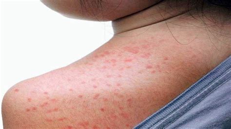 Sweat Rash Home Remedies: स्वैट रैश या हीट रैश से बचाव के लिए घरेलू ...