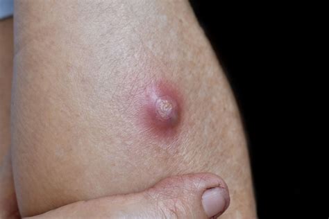 pictures  staph infections   stage