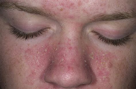 Exposed - Seborrhea, Dermatitis and Seborrhea Conditions - Treatment ...