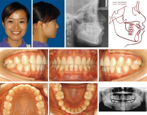 orthodontic premolar extraction  isabella embry blog
