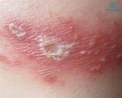 dau hieu va cach xu ly kien ba khoang