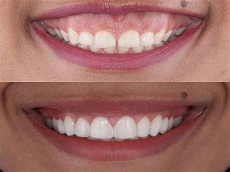 laser gum contouring gummy smile surgery dental dental veneers