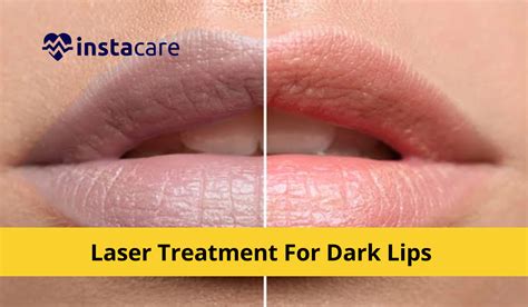 laser treatment  dark lips
