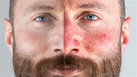 Type 3 Phymatous Rosacea Nose & Face Symptoms + Proven Treatment